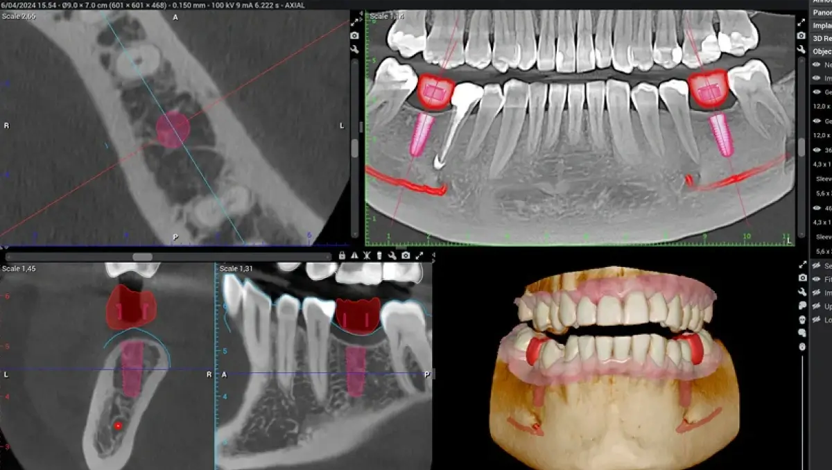 Dental implant X-ray and model at Dental Elements in Shawnee, Leawood and Wellsville, KS